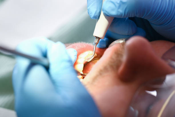 Best Emergency Tooth Extraction in Ironton, MO